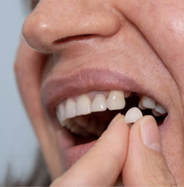 What Happens If the Bone Shrinks After Tooth Loss?