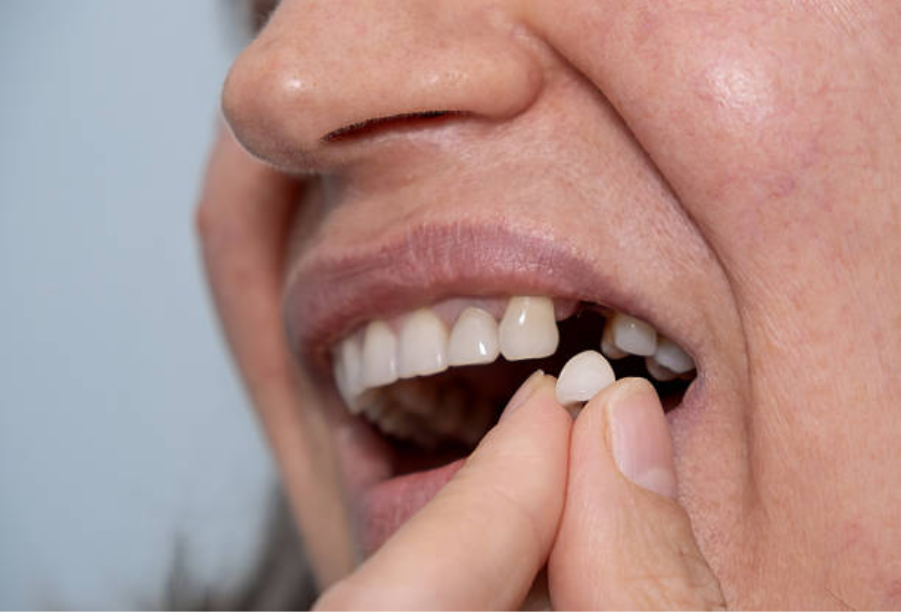 What Happens If the Bone Shrinks After Tooth Loss?